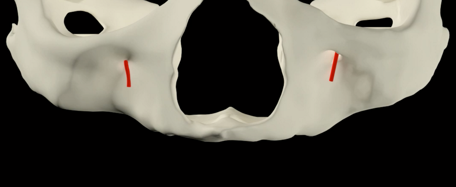 New zygomatic implant design